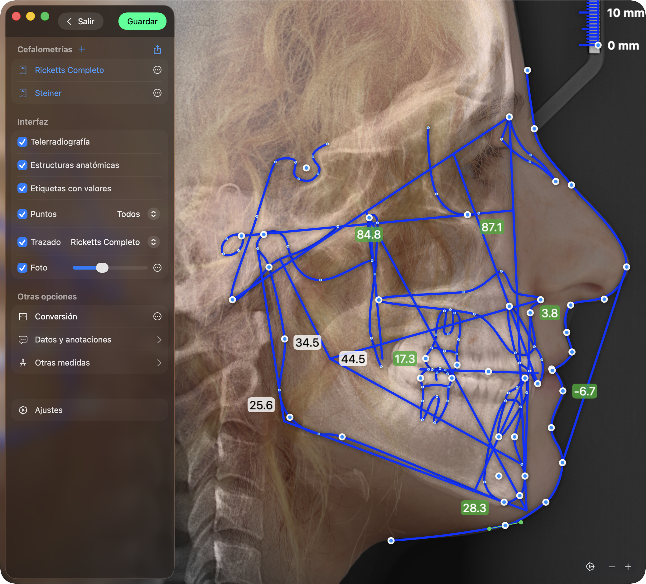 Trazado cefalométrico automático con IA en OrthoKit sobre una telerradiografía lateral