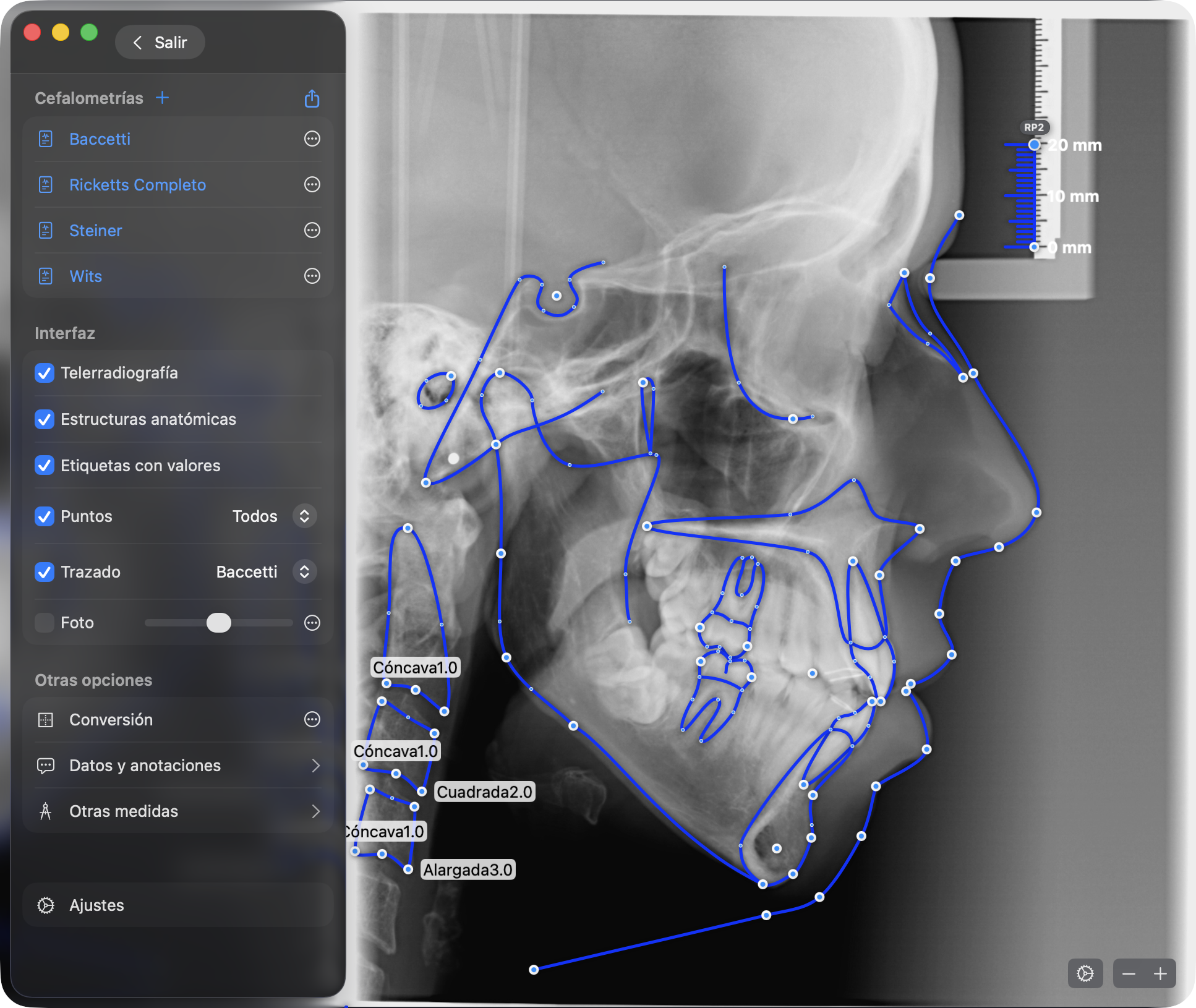 Complete AI-assisted cephalometric tracing in OrthoKit