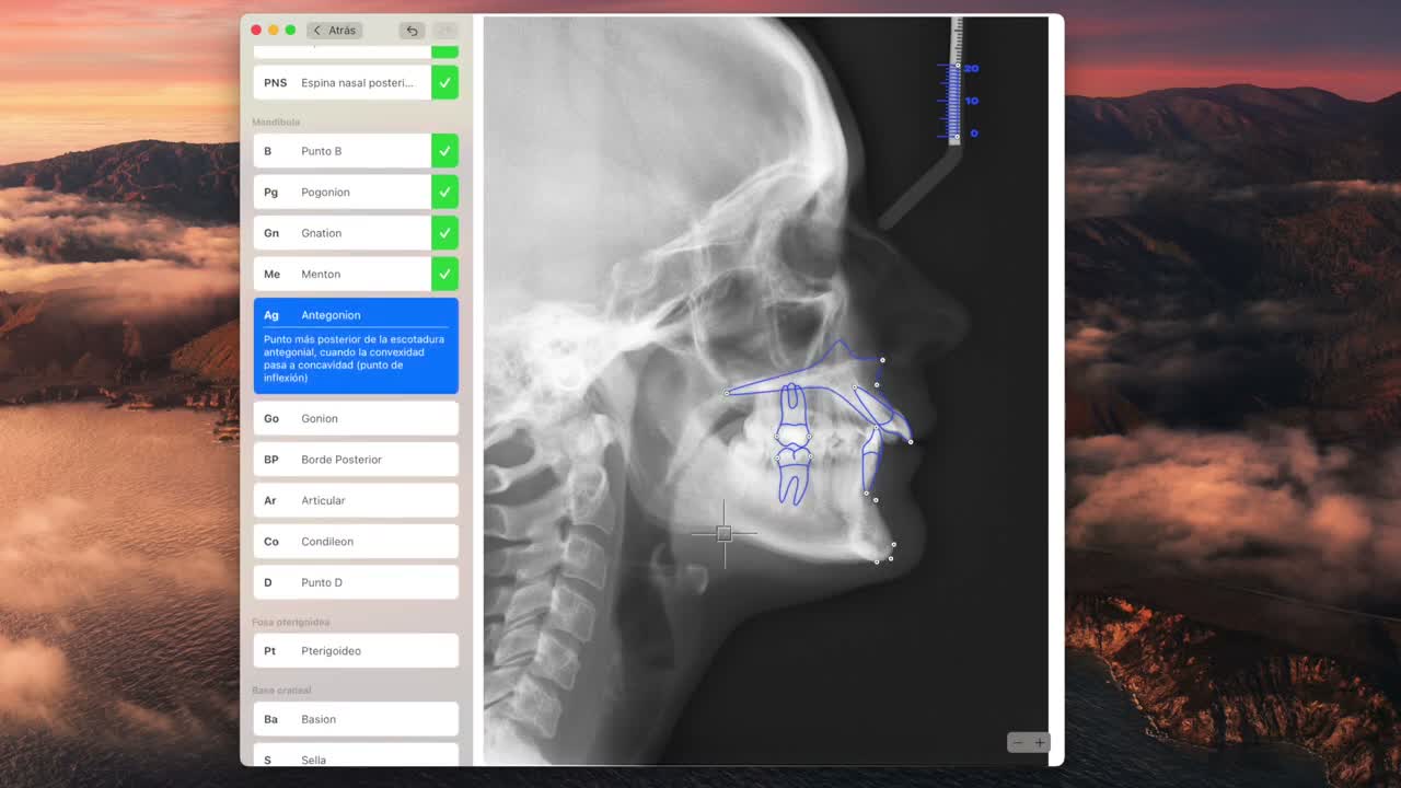 Cephalometric tracing on macOS - screenshot 3